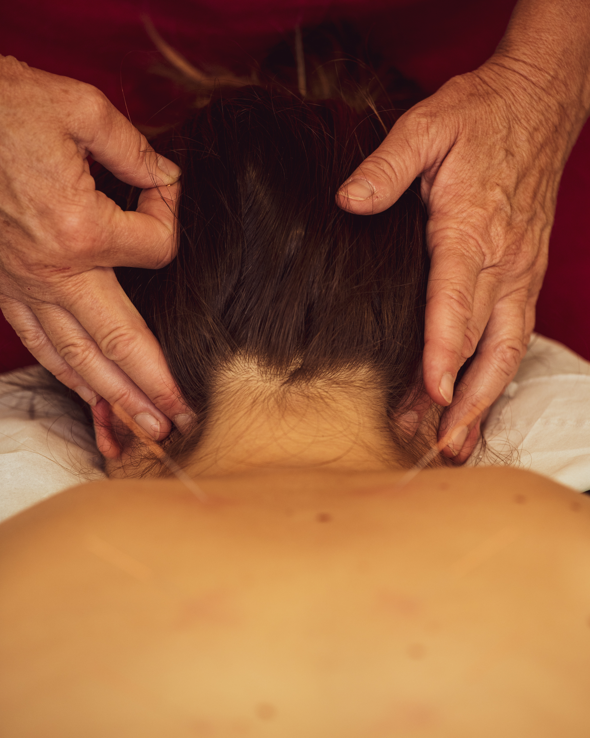 Hands placing acupuncture needles during a treatment